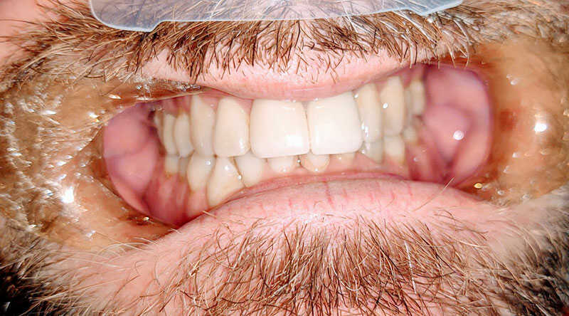 After - Full Smile Restoration