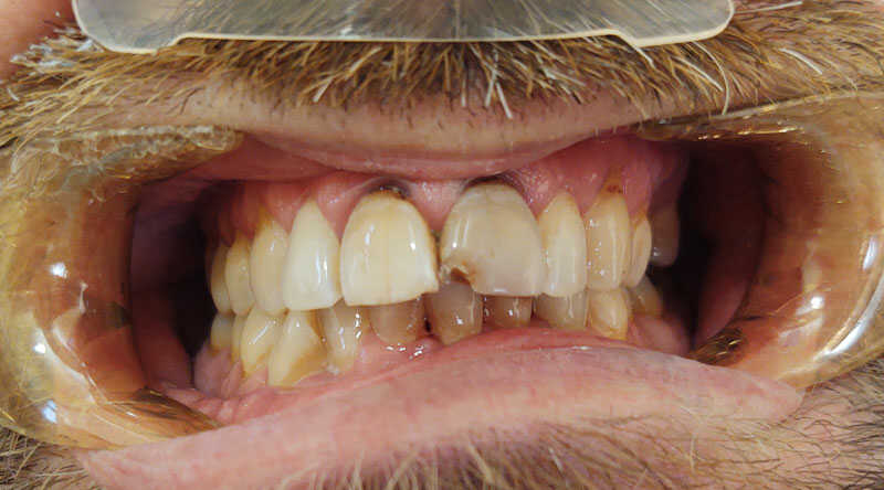Before - Full Smile Restoration