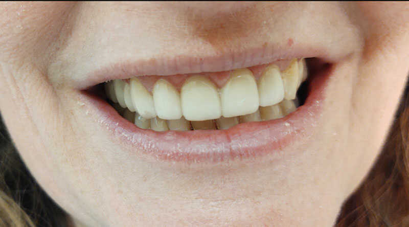 After - Cosmetic Enhancement