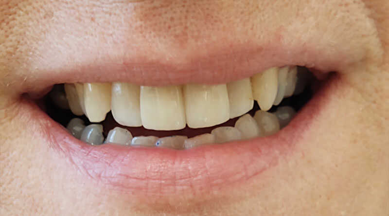 After - Smile Makeover