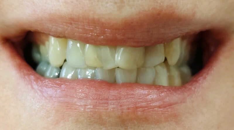 Before - Smile Makeover